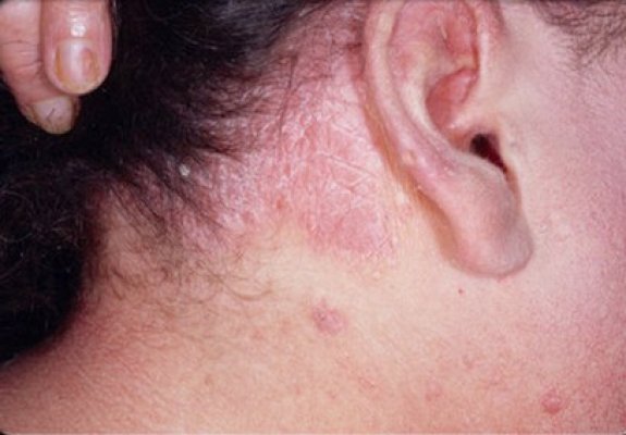CJAS, mesaj în atenţia medicilor dermatologi care au pacienţi cu psoriazis
